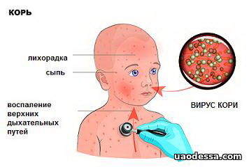 Шестеро одесских детей заболели корью за прошлую неделю